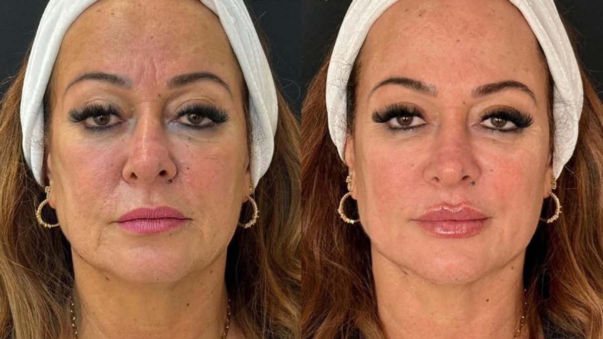 Nadine Gonçalves investe em rejuvenescimento com técnicas modernas e surpreendentes
