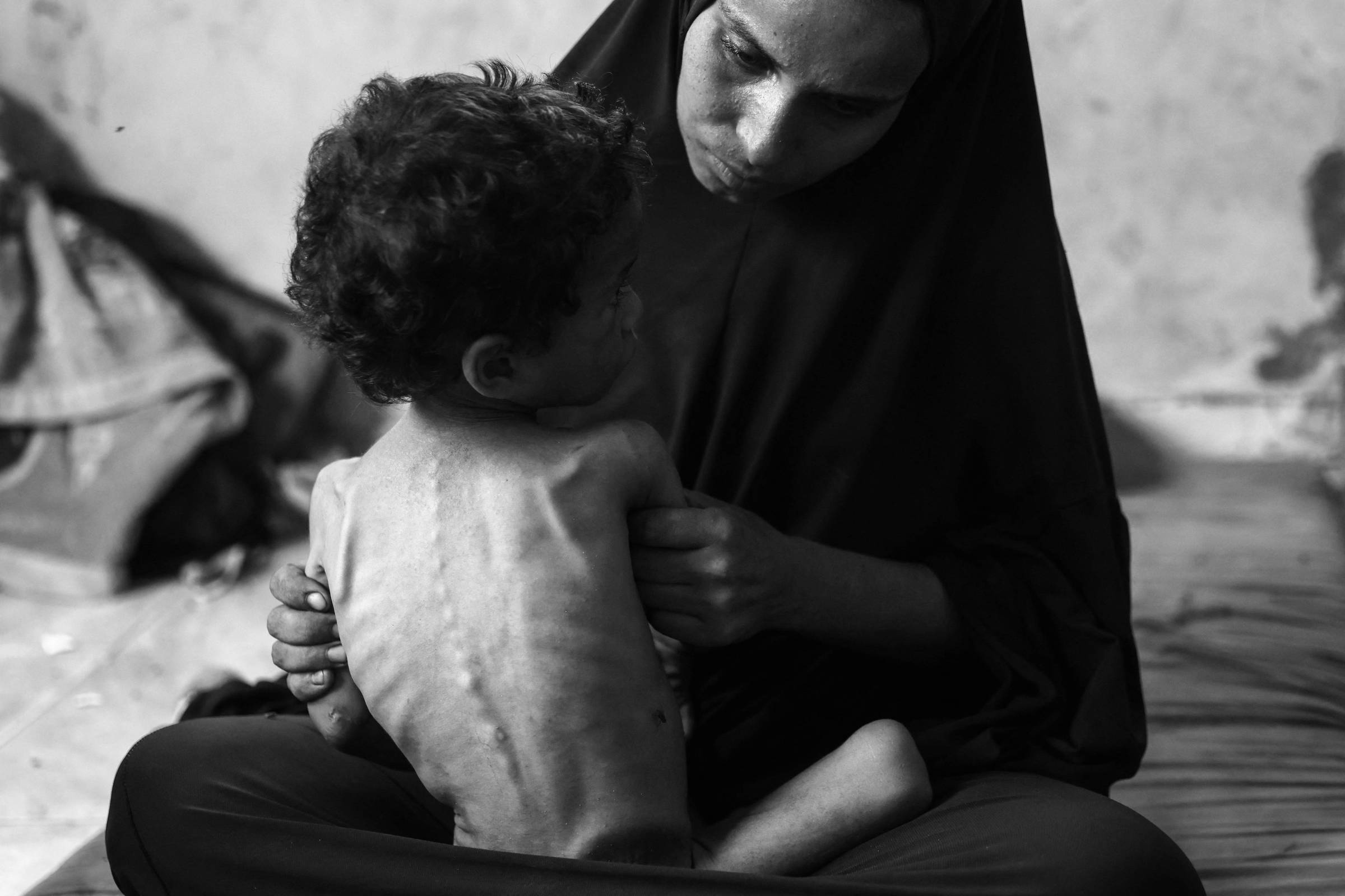 Mulher palestina segura filho que sofre de desnutrição, em campo de refugiados em Gaza (Foto: Omar Al-Qattaa - 23.jul.25/AFP)