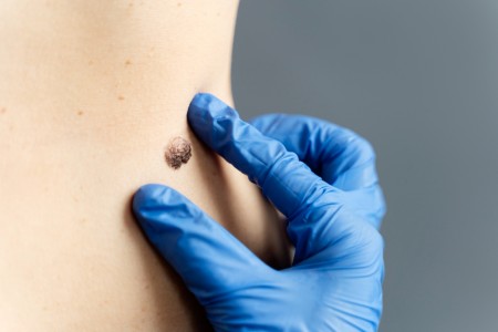 Entre os diferentes tipos de imunoterapia, o bloqueio da proteína PD-1 se tornou a abordagem padrão para casos avançados de melanoma. No entanto, entre 40% e 60% dos pacientes não respondem bem a essa abordagem e o tratamento pode custar entre R$ 30 mil e R$ 40 mil por mês (Foto: Freepik)