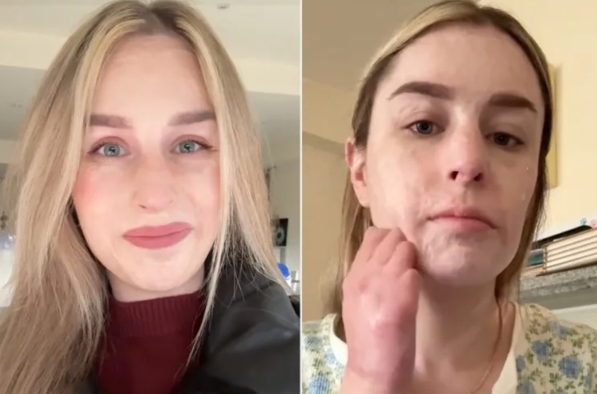 Mulher que sobreviveu a erupção vulcânica revela progresso em sua recuperação Stephanie Coral Browitt se adaptou ao seu novo estilo de vida (Foto: Reprodução/TikTok)