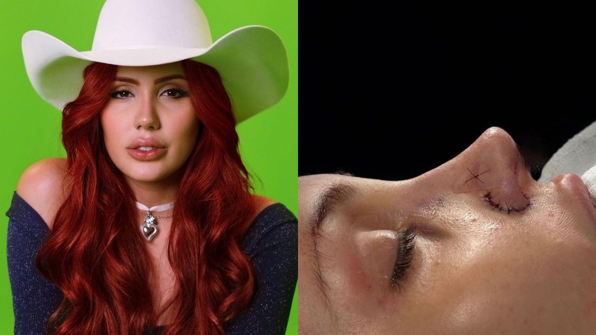 Após passar por uma rinoplastia, Alicia X compartilhou como tem sido o processo de recuperação após a realização (Foto: Divulgação)