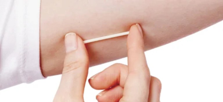 SUS disponibiliza novo implante contraceptivo moderno para a população Foto: Reprodução
