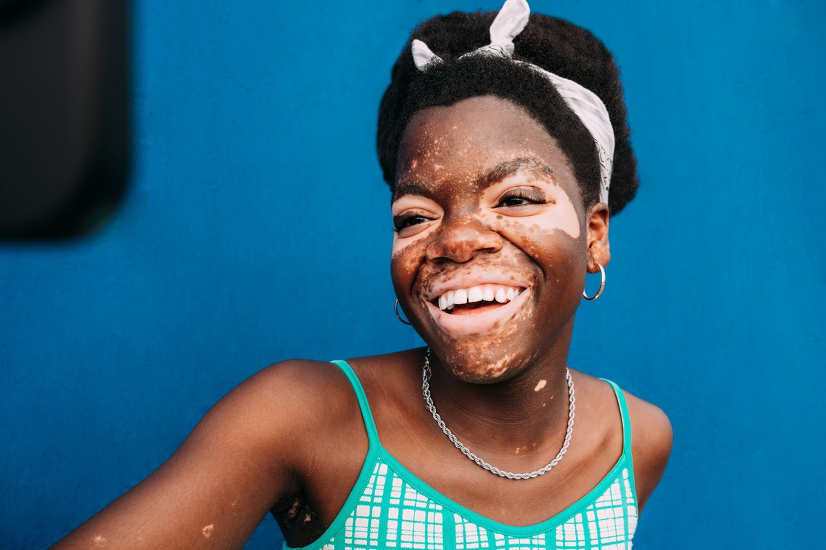 Vitiligo: entenda causas, tratamentos e como lidar com o estigma da condição de pele Vitiligo: o que é, causas, tratamento e como combater o estigma da condição de pele (Foto: Getty Images)