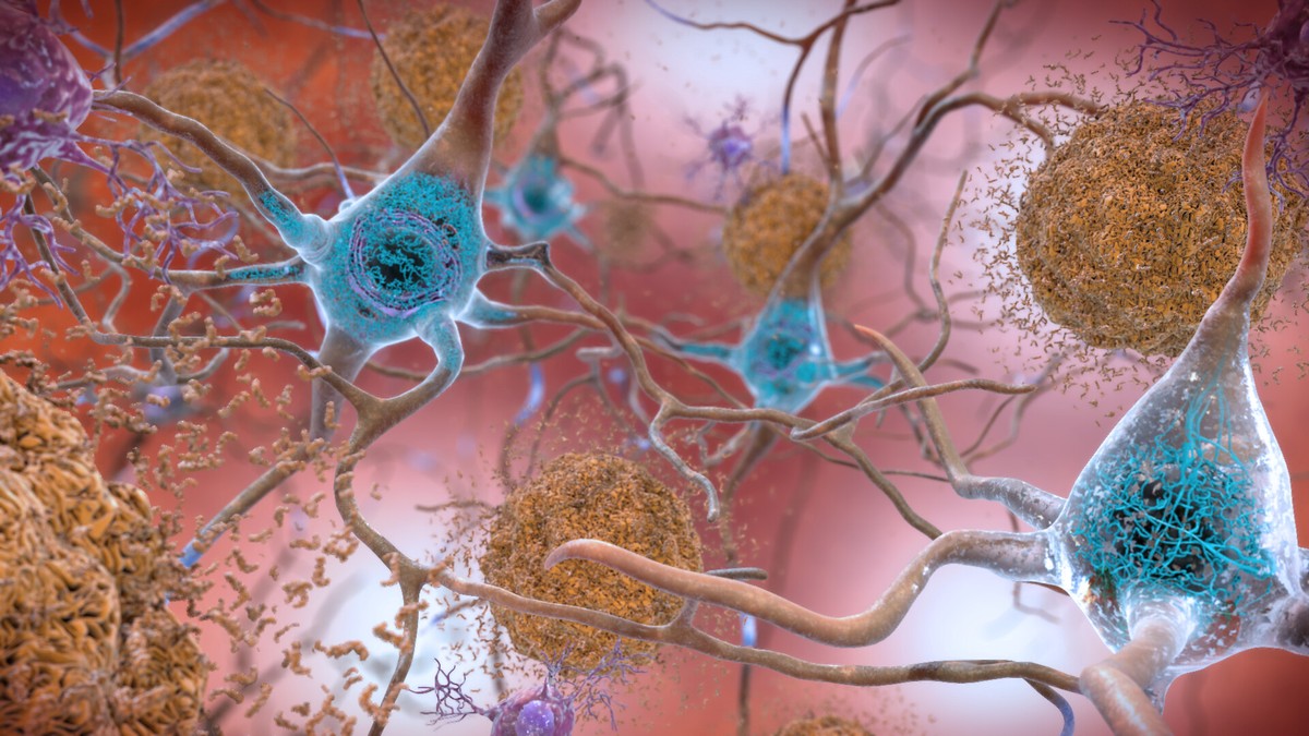 Caso mais jovem de Alzheimer é registrado em paciente com menos de 20 anos Ilustração mostra placas de proteína beta-amiloide (em laranja) entre neurônios de paciente com Alzheimer (Foto: NIAID-NIH)