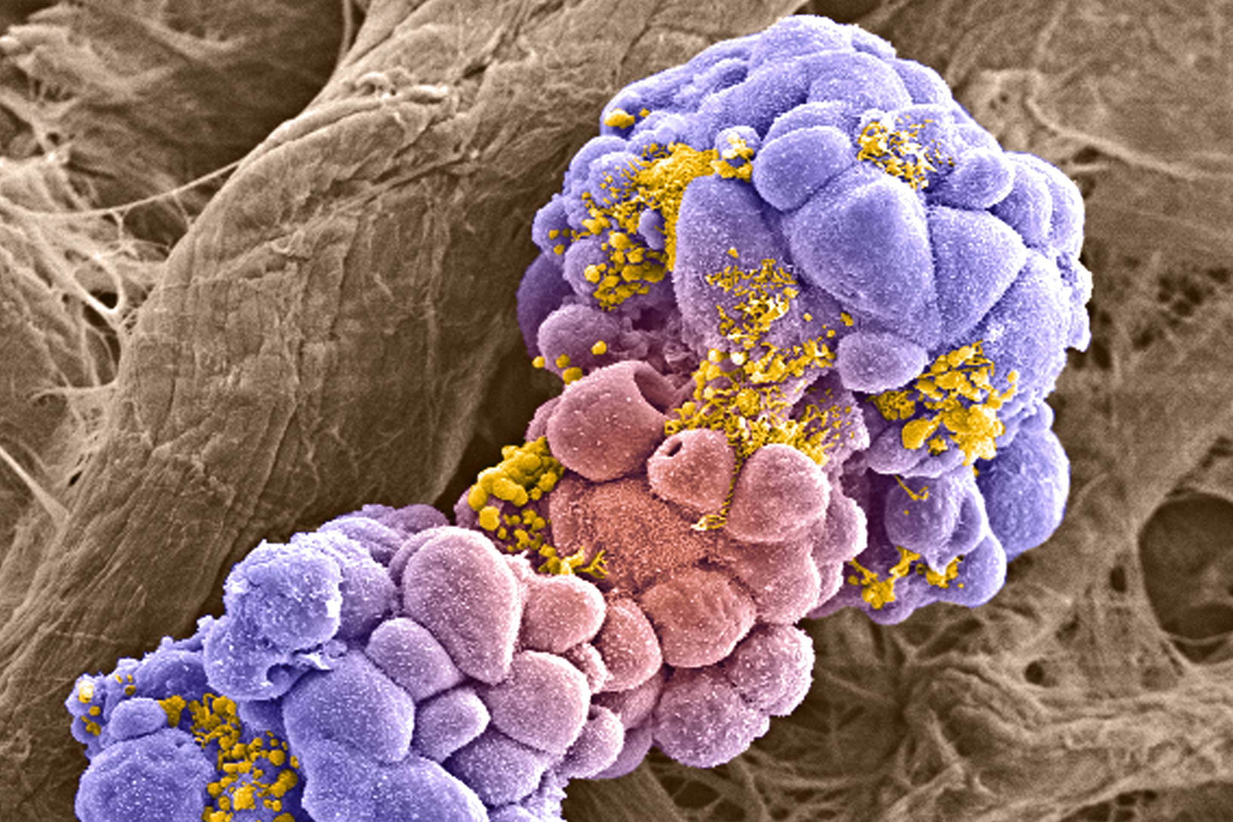 Avanços promissores na luta contra o câncer trazem esperança à medicina moderna Células de câncer de mama vistas com auxílio de microscópio eletrônico; a imagem foi colorida em computador (Foto: Khuloud T. Al-Jamal, David McCarthy e Izzat Suffian)
