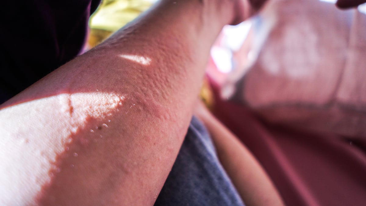 O braço de um homem com erupções cutâneas. (Foto: Fajrul Islam/Getty Images)