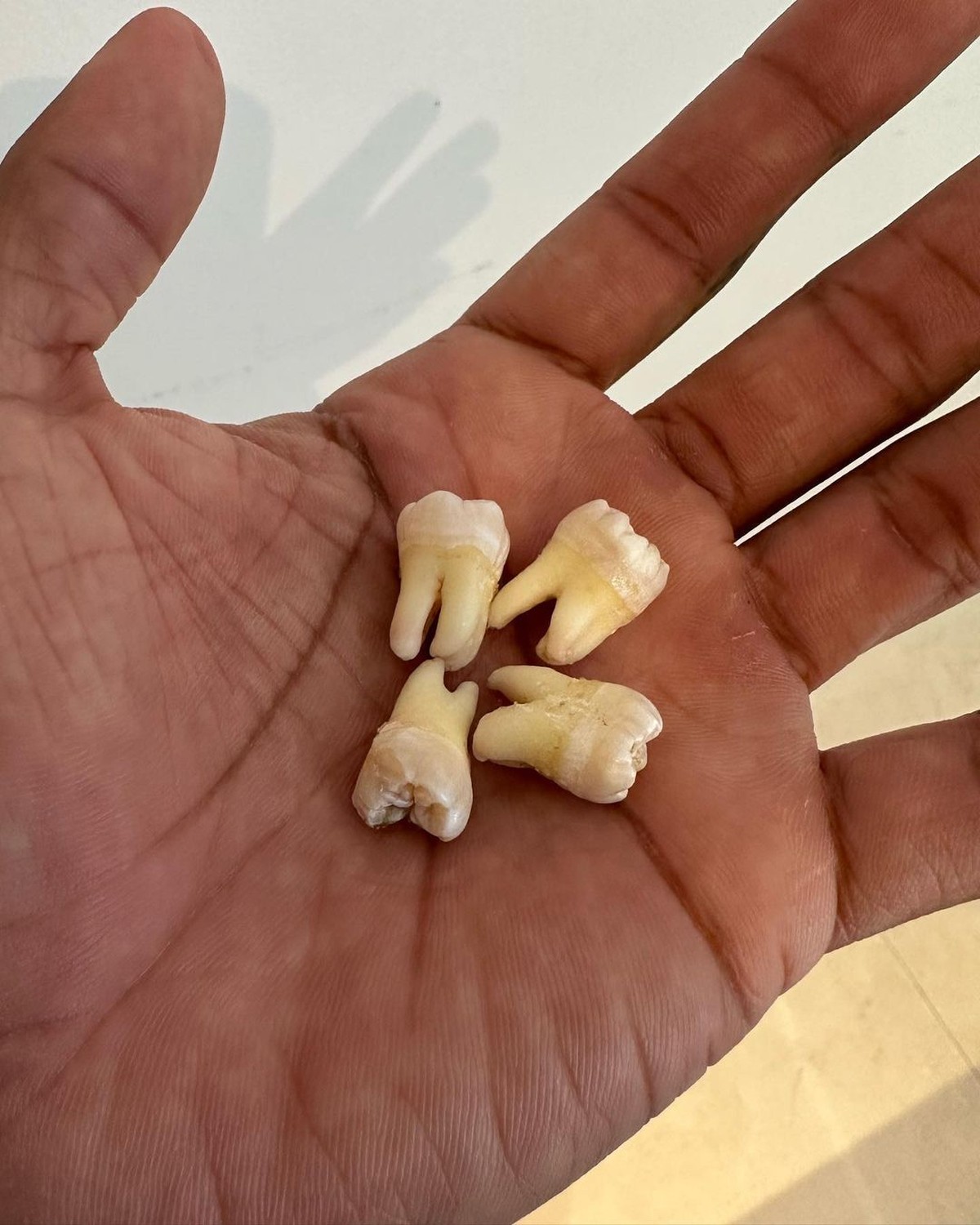Já sonhou com dentes caindo? A ciência explica por que isso acontece (Foto: Reprodução/Instagram/@iampauloandre)
