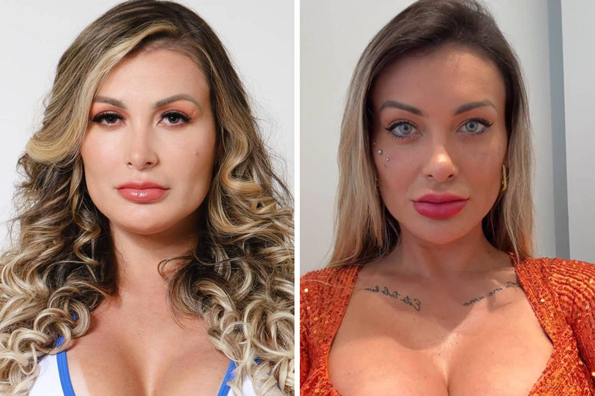Andressa Urach expressa arrependimento por cirurgia para mudar a cor dos olhos Andressa Urach revela complicações após cirurgia para mudar a cor dos olhos (Foto: Instagram)