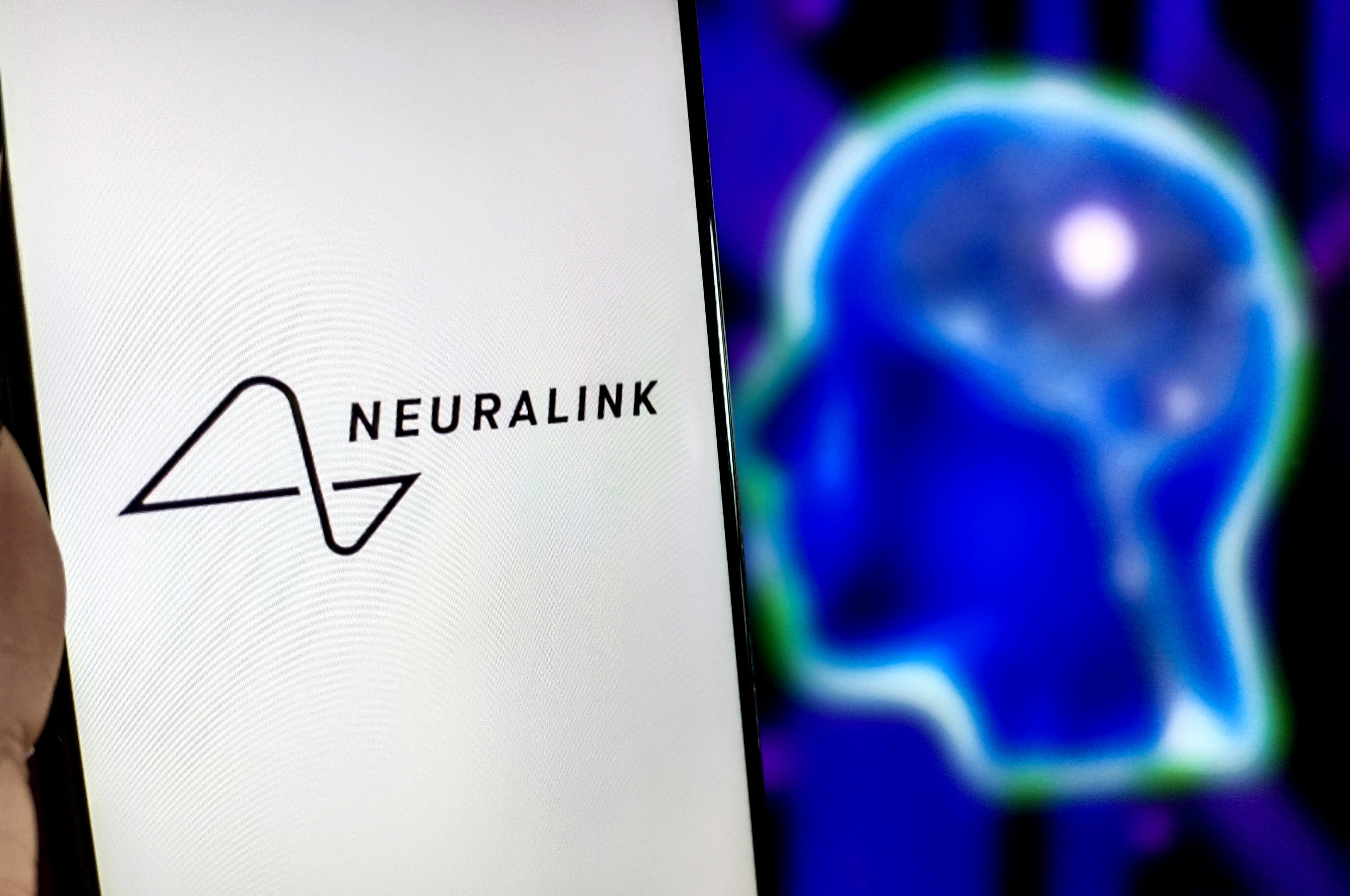 Atualmente, a Neuralink afirma que cinco pacientes com paralisia severa utilizam seu dispositivo para controlar ferramentas digitais e físicas com seus pensamentos (Foto: Getty Images)
