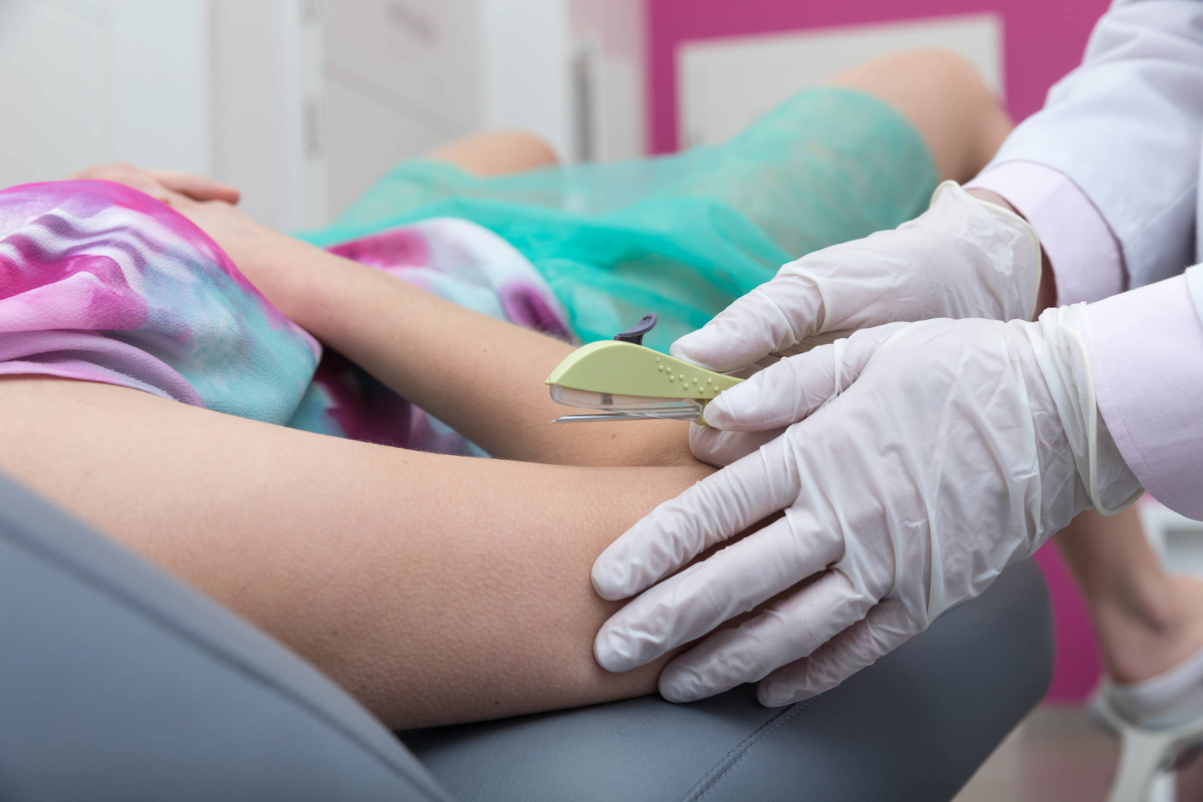 Implanon será disponibilizado no SUS como novo método contraceptivo ainda este ano Aplicação de implante subcutâneo para contracepção hormonal (Foto: Adobe Stock)