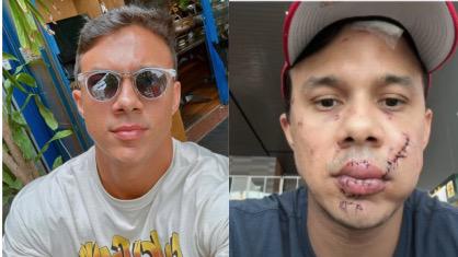 Homem admite ter desfigurado personal trainer em ataque no interior de SP Medeiros foi agredido após tentar impedir ação do agressor contra mulheres em bar no interior de São Paulo (Foto: Reprodução/Redes Sociais/Reprodução)