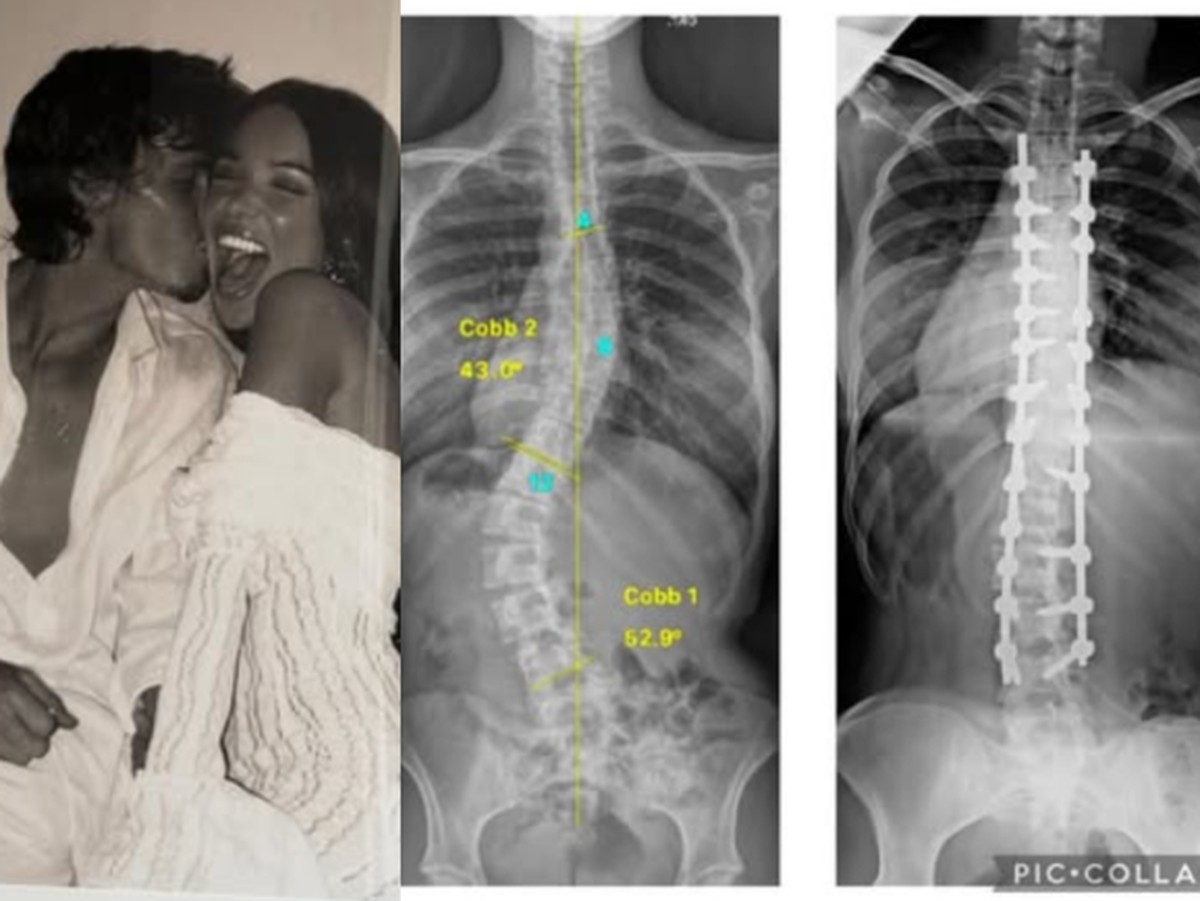 Nora dos Beckham relata 'inferno absoluto' após cirurgia na coluna e se declara a Cruz Jackie Apostel relata desafios de cirurgia na coluna (Foto: Reprodução/Instagram)