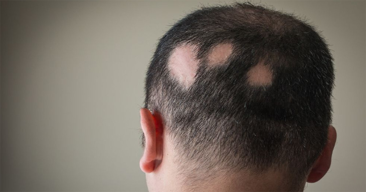 Alopecia areata gera debates sobre a necessidade de diretrizes mais eficazes Homem de costas com alopecia areata; o cabelo tem falhas em formatos circulares (Foto: USP Imagens)